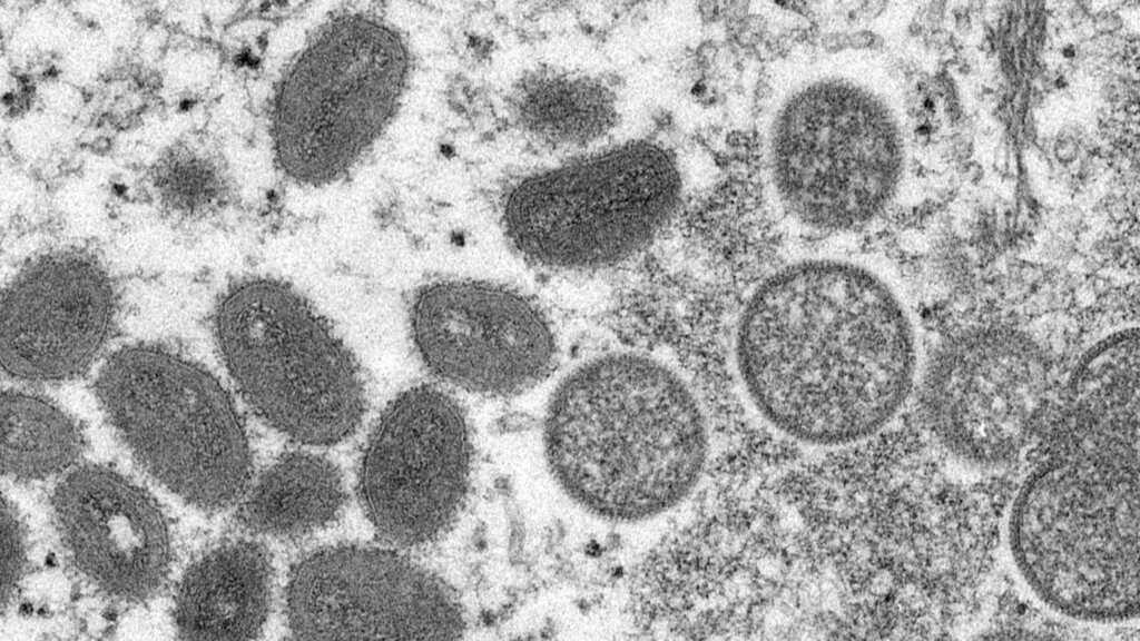 Was monkeypox already circulating in UK? Scientists have interesting answers