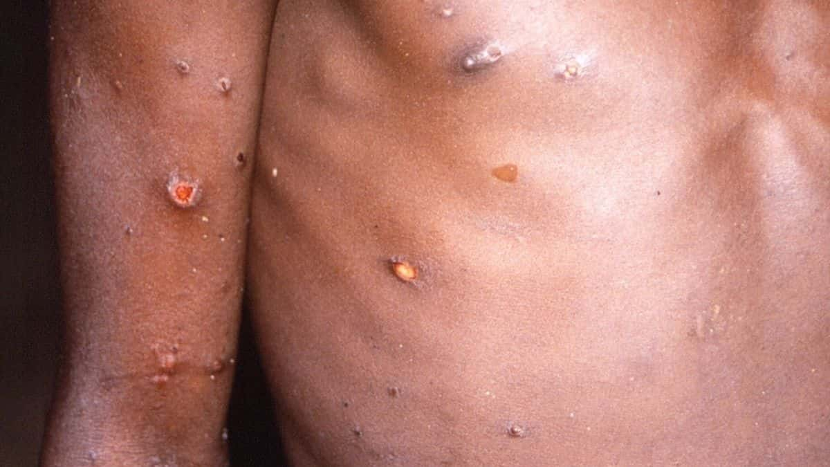 Monkeypox outbreaks: A list of countries that recorded cases recently. Will  it be like COVID-19 pandemic? - World News