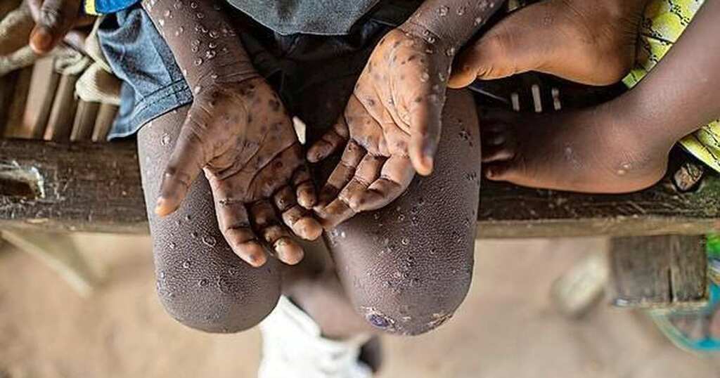 Panic vs Prevention: Should we worry about Monkeypox outbreak?