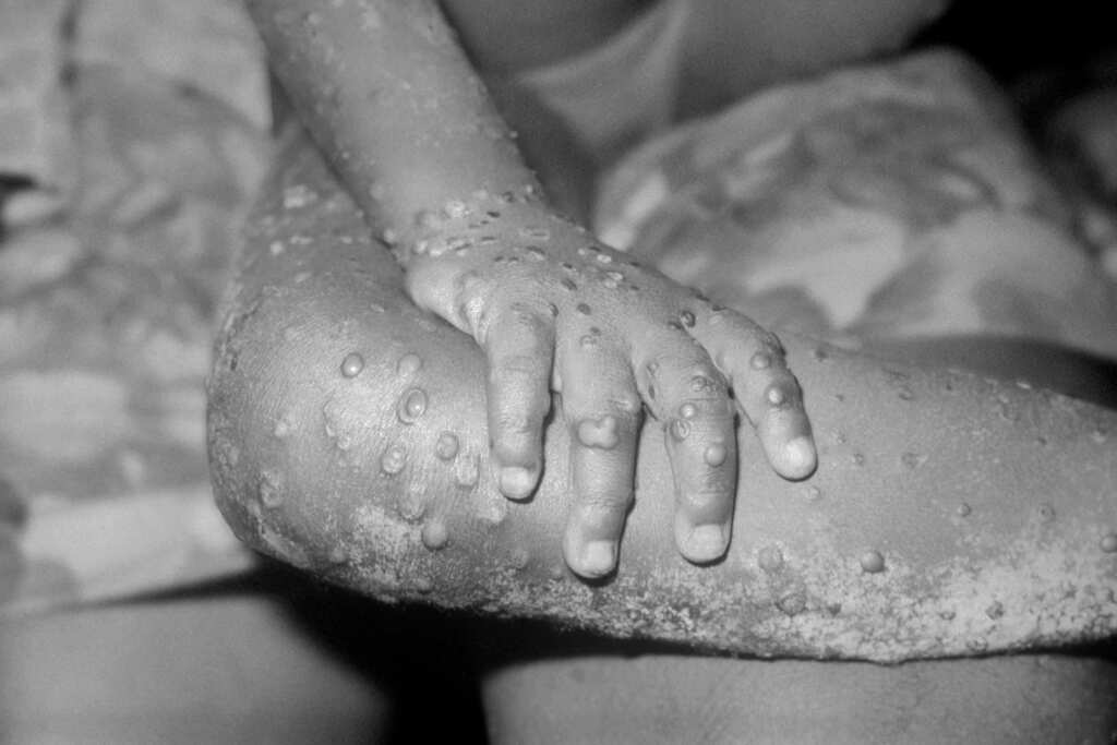 Israel reports first case of Monkeypox, alarm over new infection
