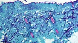 Monkeypox Explained: Types, symptoms, causes, and treatment