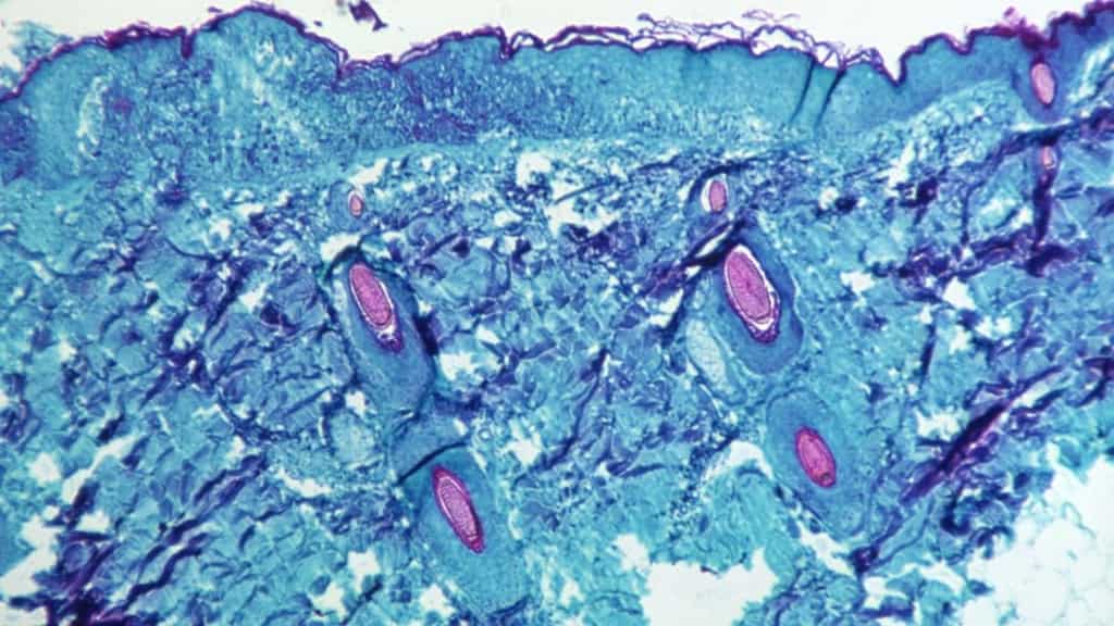 Monkeypox Explained: Types, symptoms, causes, and treatment