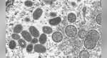 Monkeypox in India: Int'l travellers with symptoms to be directly sent to Delhi hospital from airport