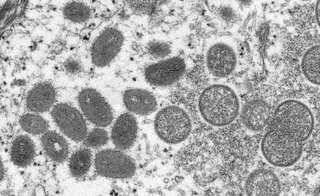 Monkeypox outbreak: All that you need to know about the virus