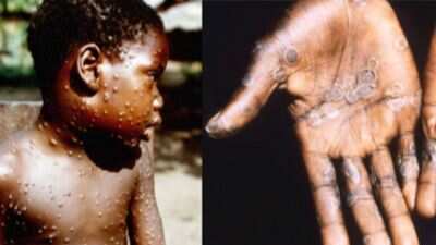 UK: Monkeypox cases rises to 57, UK authorities issue advisory amidst spike