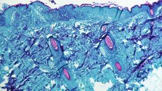 Monkeypox: New study shows symptoms are making recognition of case more difficult