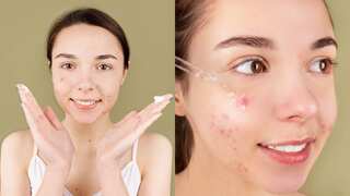 From the best anti-acne diet to skincare routine: Expert guide to get rid of zits