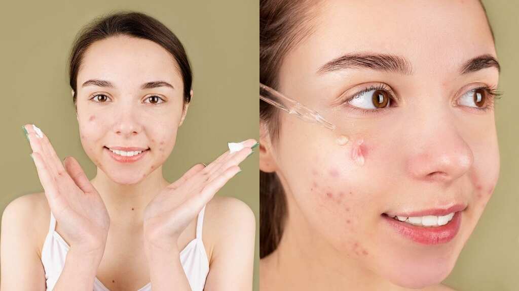 From the best anti-acne diet to skincare routine: Expert guide to get rid of zits