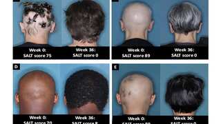 US FDA approves first oral tablet called baricitinib for treatment of alopecia