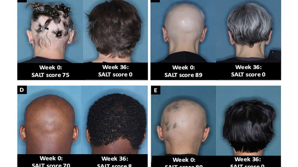 US FDA approves first oral tablet called baricitinib for treatment of alopecia