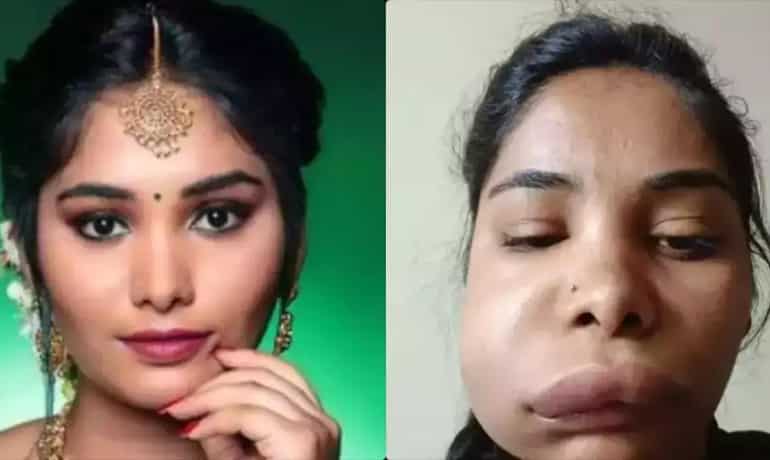 Indian actress Swathi Sathish root canal surgery goes wrong, netizens says nothing to worry Indian actress Swathi Sathish root canal surgery goes wrong, netizens says nothing to worry