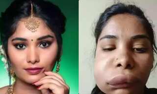 Indian actress Swathi Sathish root canal surgery goes wrong, netizens says nothing to worry