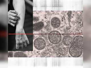 WHO declares Monkeypox outbreak a global health emergency