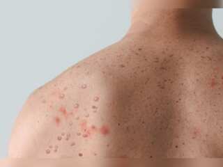 Global Monkeypox Outbreak: 75 countries, 16,000 cases and 5 deaths