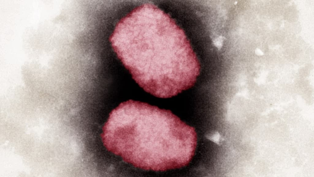 Monkeypox outbreak: Brazil reports first death outside Africa