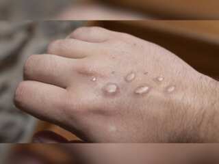 WHO declares global health emergency over Monkeypox outbreak