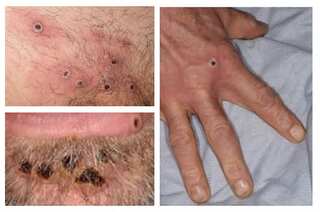 Monkeypox virus can remain on blankets, coffee machines for days, says CDC study