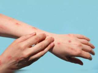 Spain reports first Monkeypox-related death in Europe; One death also reported in Brazil