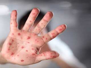 Monkeypox Outbreak: How it spreads, who is at risk?