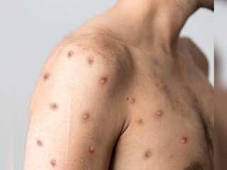 WION Fineprint: All that you need to know about Monkeypox