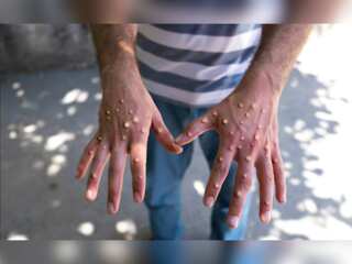 WION Dispatch | India: Kerala youth with Monkeypox-like symptoms dies