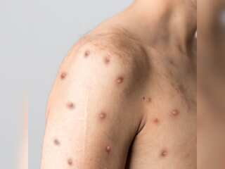 Monkeypox Outbreak: US declares health emergency, India reports its first death