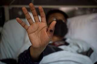 Amid surge in monkeypox spread in US, cases double in Los Angeles