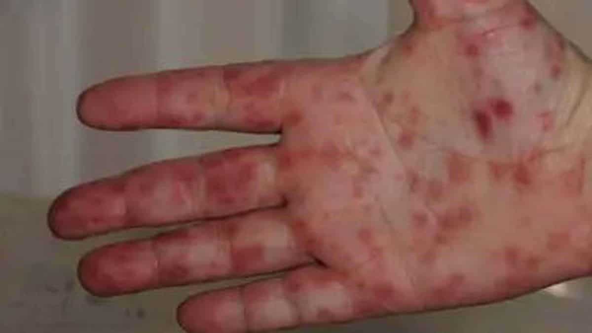 Two more states in India now affected by tomato flu outbreak 