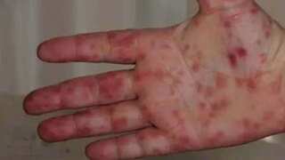 Two more states in India now affected by tomato flu outbreak 