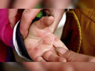 Tomato flu: Suspected virus affecting kids in India under age of 5
