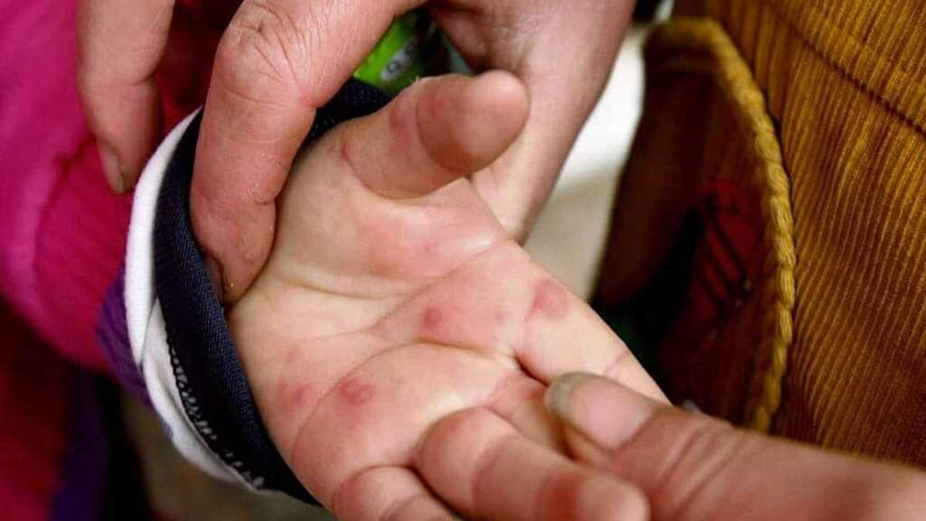 Tomato flu: Suspected virus affecting kids in India under age of 5