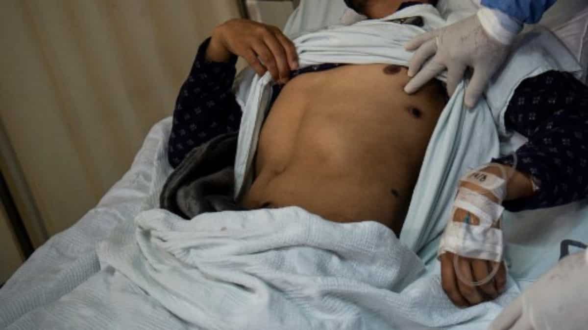 Hong Kong records first suspected case of the monkeypox virus: Report ...