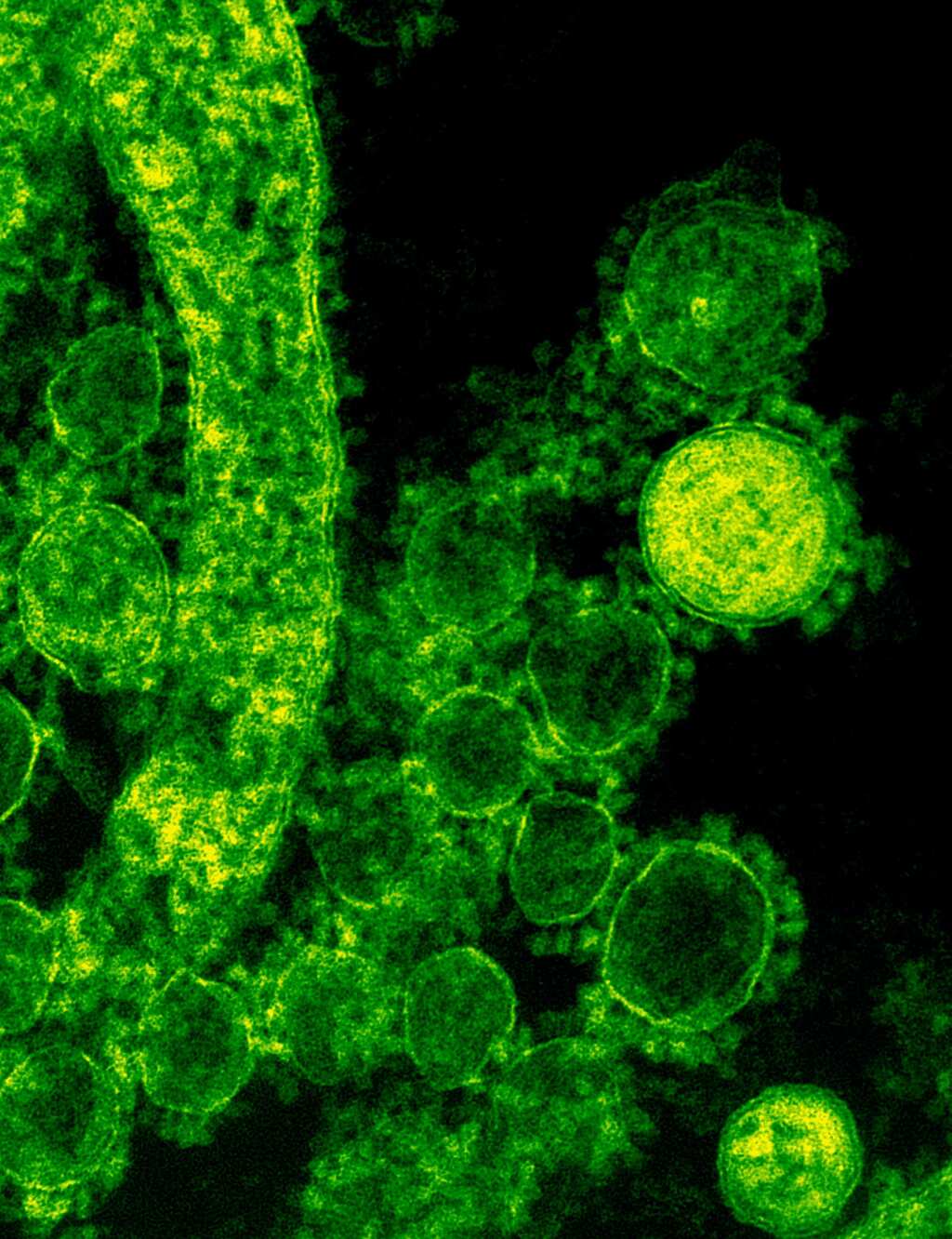 Scientists find novel cell based therapy to treat metastatic melanoma