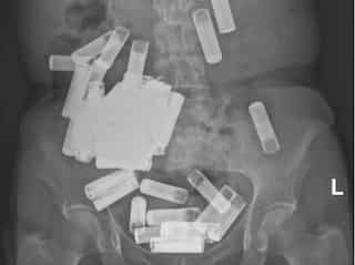 Ireland doctors remove 'highest' 55 batteries from woman's gut and stomach