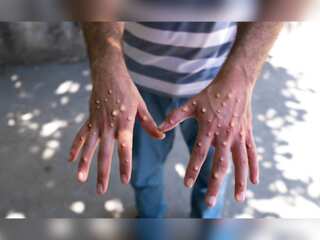 'Do not touch foreigners to avoid monkeypox', Chinese doctor tells citizens
