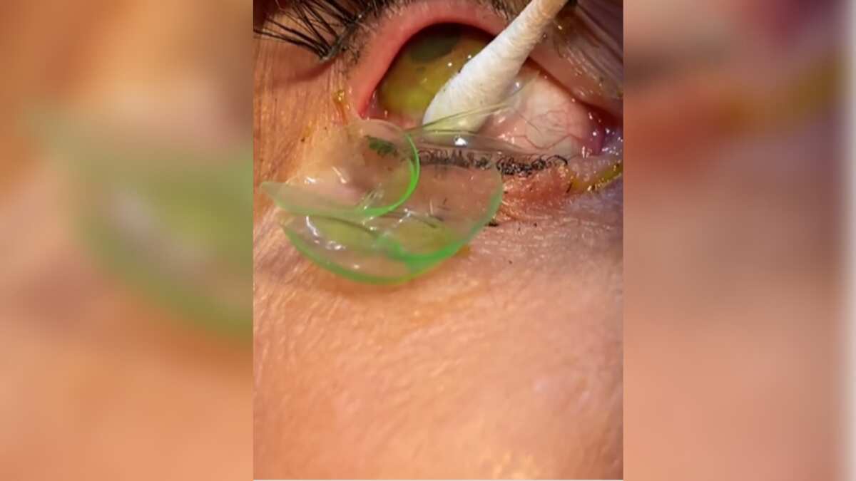Watch | US doctor removes 23 lenses from an elderly woman's eyes, netizens shocked