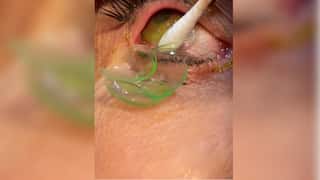 Watch | US doctor removes 23 lenses from an elderly woman's eyes, netizens shocked