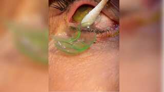 Watch | US doctor removes 23 lenses from an elderly woman's eyes, netizens shocked