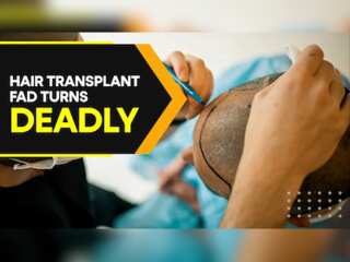 Seemingly harmless hair transplant turns fatally wrong for India's Athar Rasheed
