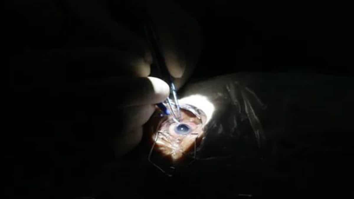 Lasik patients should be cautioned of complications, proposes US health agency Lasik patients should be cautioned of complications, proposes US health agency