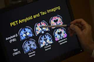 Eli Lilly's new Alzheimer's drug shows promise of slowing down memory decline
