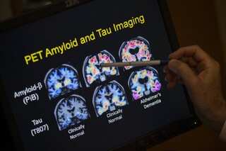 Explained: FDA approves new Alzheimer's medicine for early-stage patients, but what are the safety concerns?