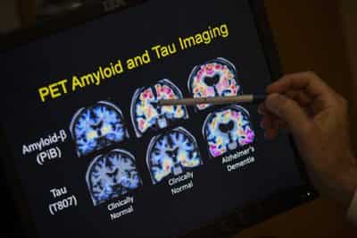 Eli Lilly's new Alzheimer's drug shows promise of slowing down memory decline