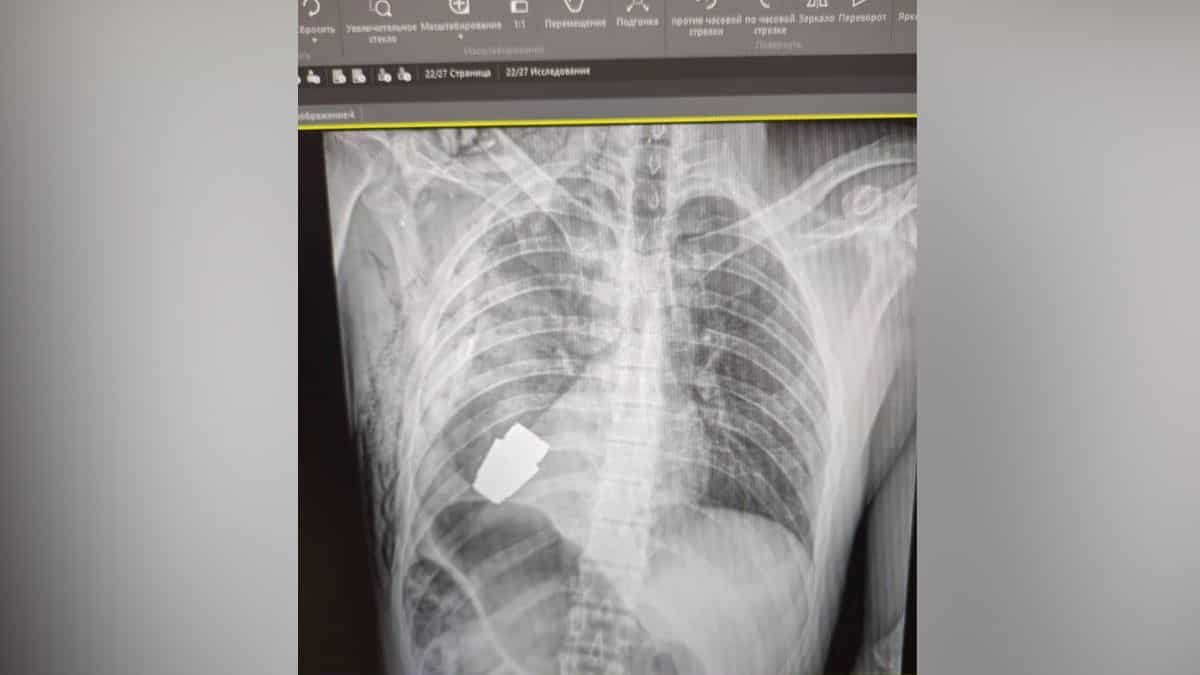 Ukrainian soldier survives surgery to remove explosive from chest