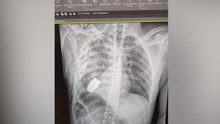 Ukrainian soldier survives surgery to remove explosive from chest