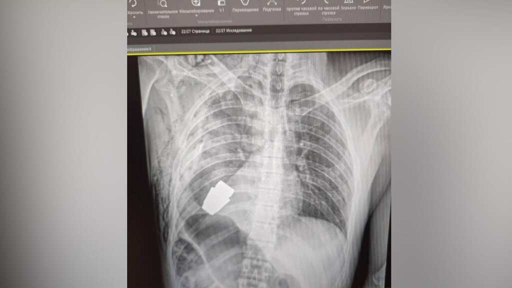 Ukrainian soldier survives surgery to remove explosive from chest