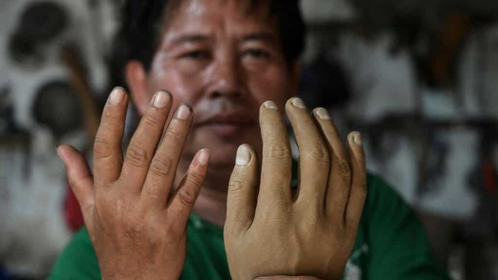 Meet Ali Saga, Indonesia's Prosthetics Limb Maker