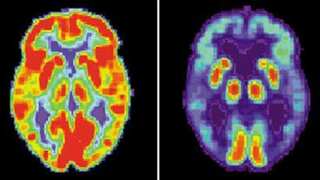 Taking sleeping pills lowers levels of Alzheimer's proteins, reveals study