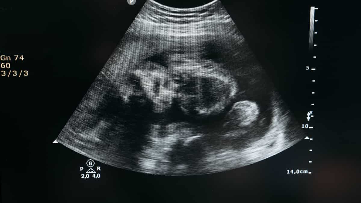 AIIMS Delhi doctors successfully operate on heart of unborn baby