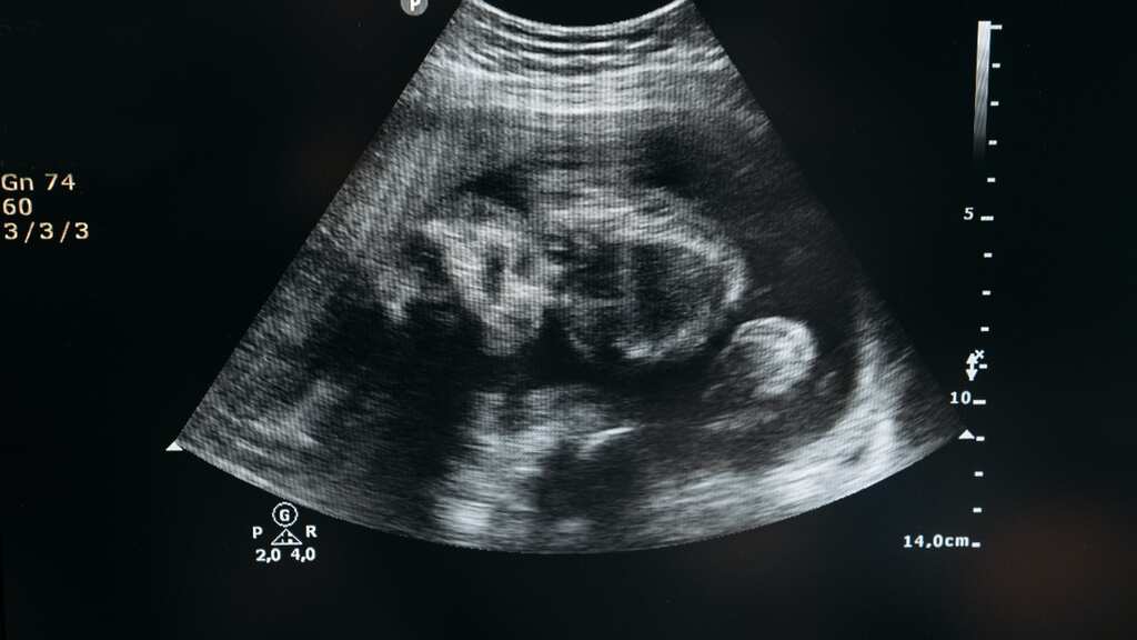 AIIMS Delhi doctors successfully operate on heart of unborn baby